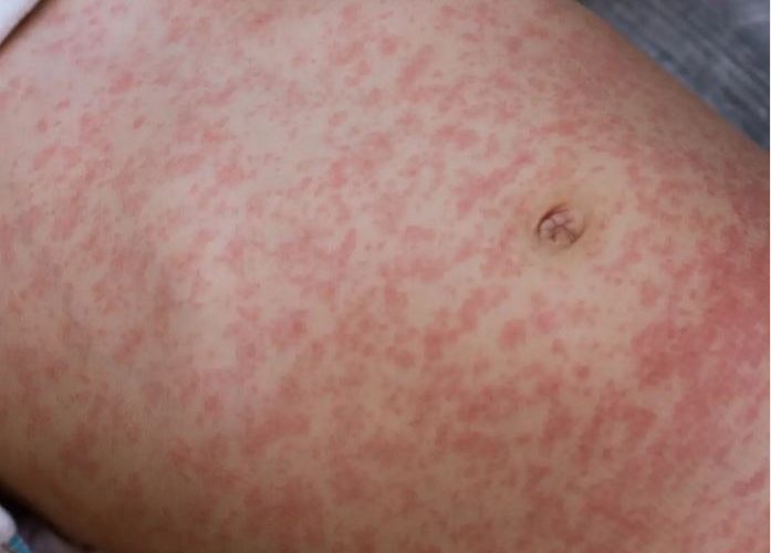 Señal y sintomanan di Measles (sarampi)