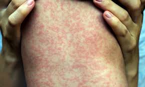 Measles (sarampi), un menasa global